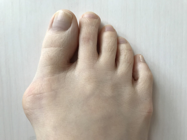 外反母趾の写真