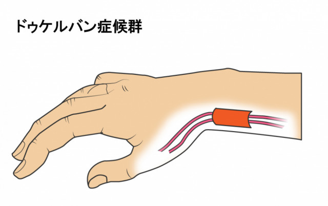 ドケルバンへの対処法は?